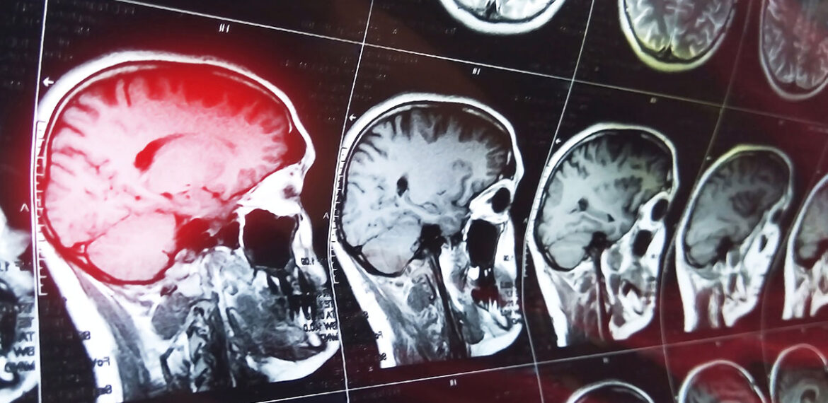 Neuro Oncology Second Opinion