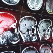 Neuro Oncology Second Opinion