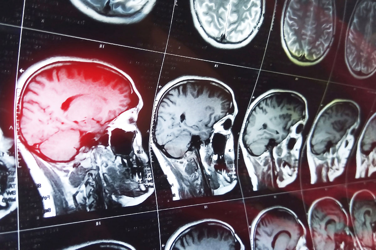 Neuro Oncology Second Opinion