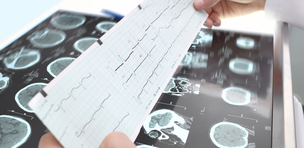 Cardiac Electrophysiology Second Opinion