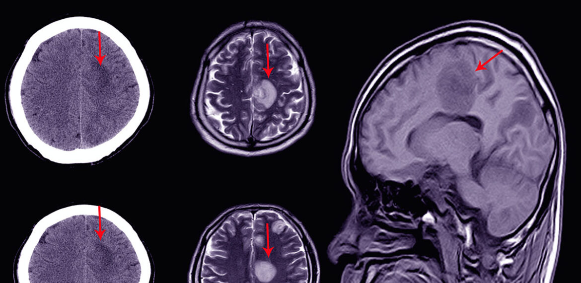 Subdural Hematoma Medical Second Opinion Services