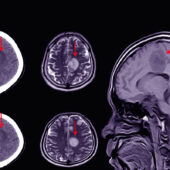 Subdural Hematoma Medical Second Opinion Services