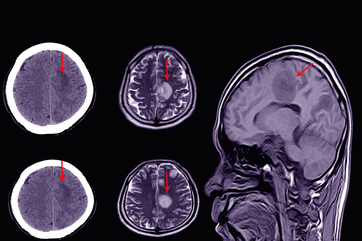 Subdural Hematoma Medical Second Opinion Services