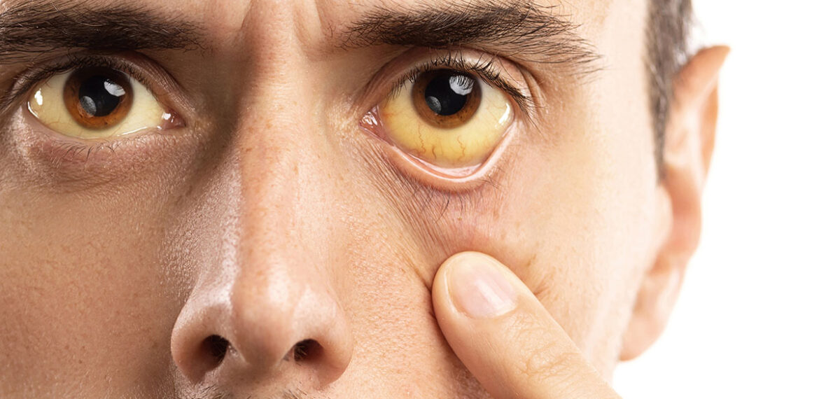 Jaundice Second Opinion