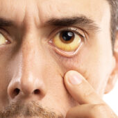 Jaundice Second Opinion