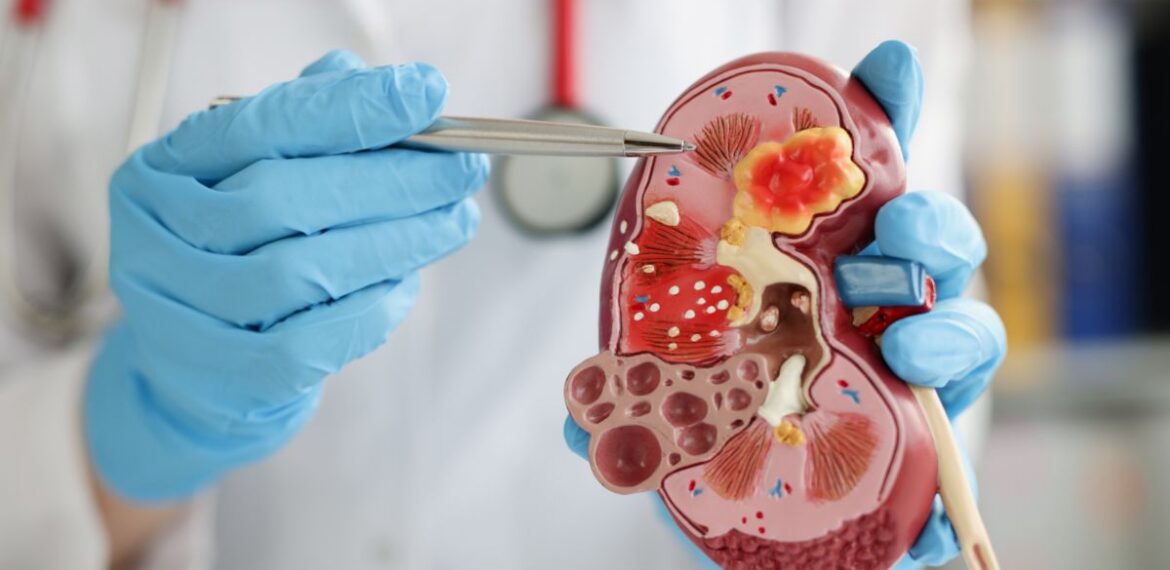 Kidney Stone Symptoms
