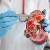Kidney Stone Symptoms