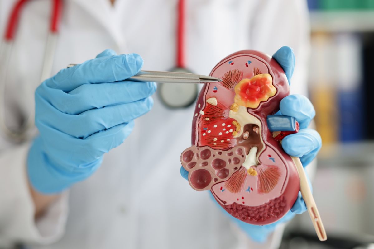 Kidney Stone Symptoms