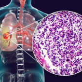 second opinion for cancer