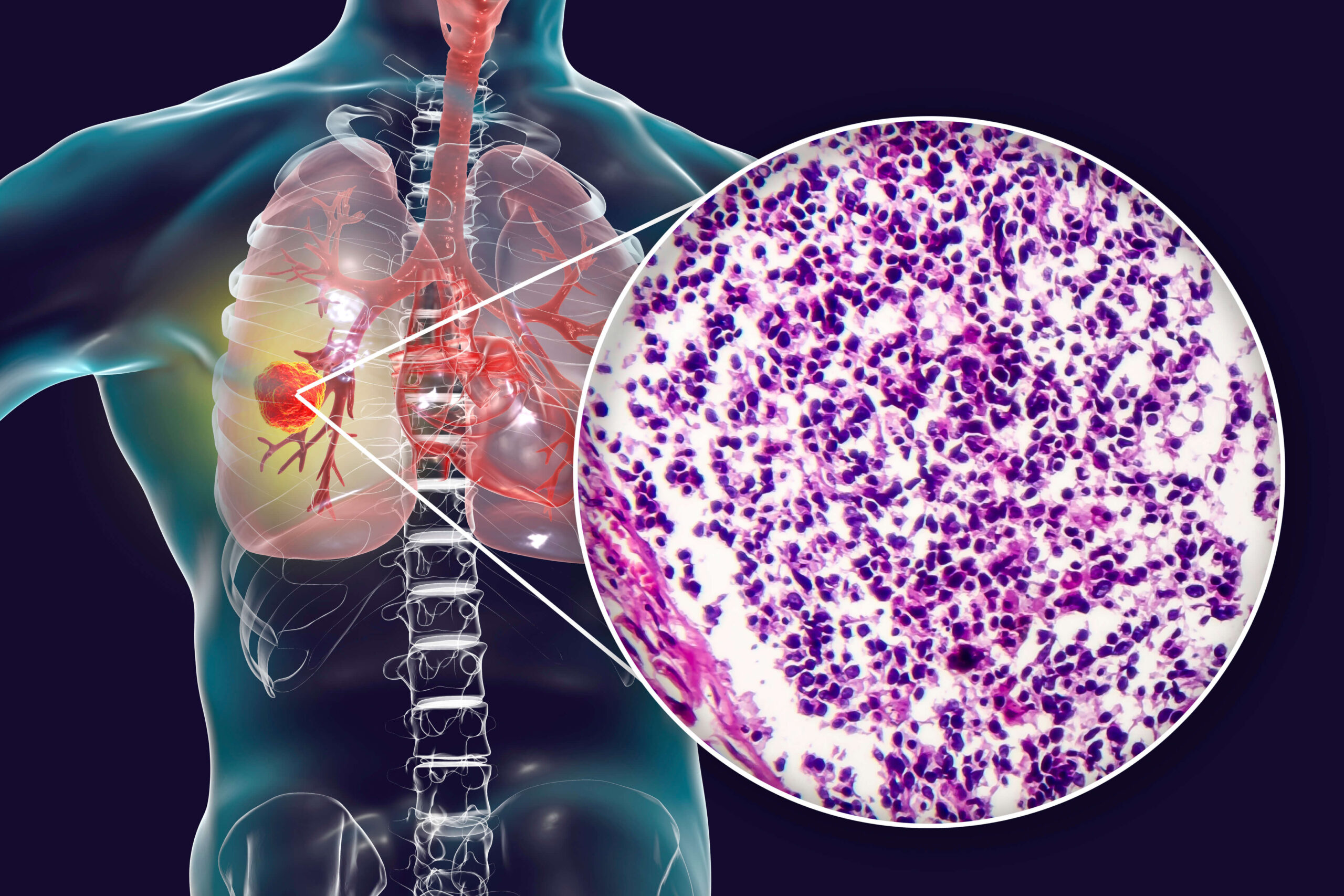 second opinion for cancer