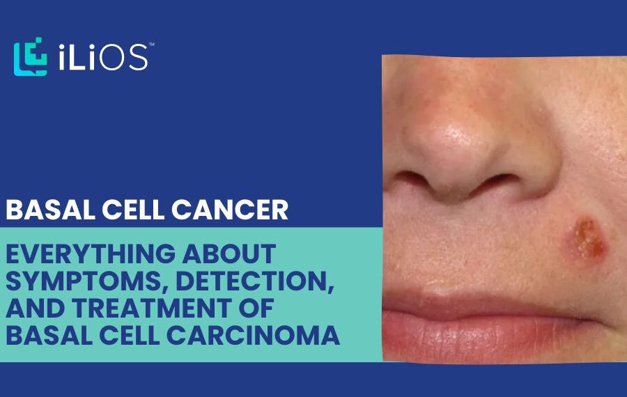 Basal Cell Cancer