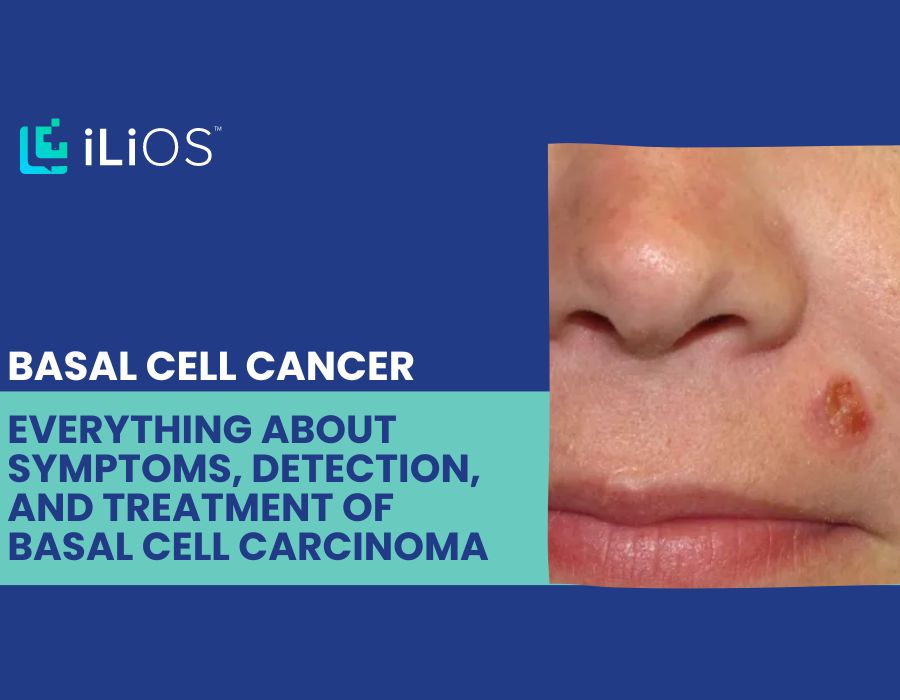 Basal Cell Cancer