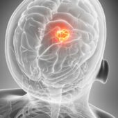 Symptoms of Brain Cancer