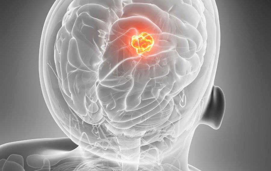 Symptoms of Brain Cancer