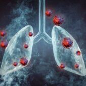 lungs cancer early symptoms