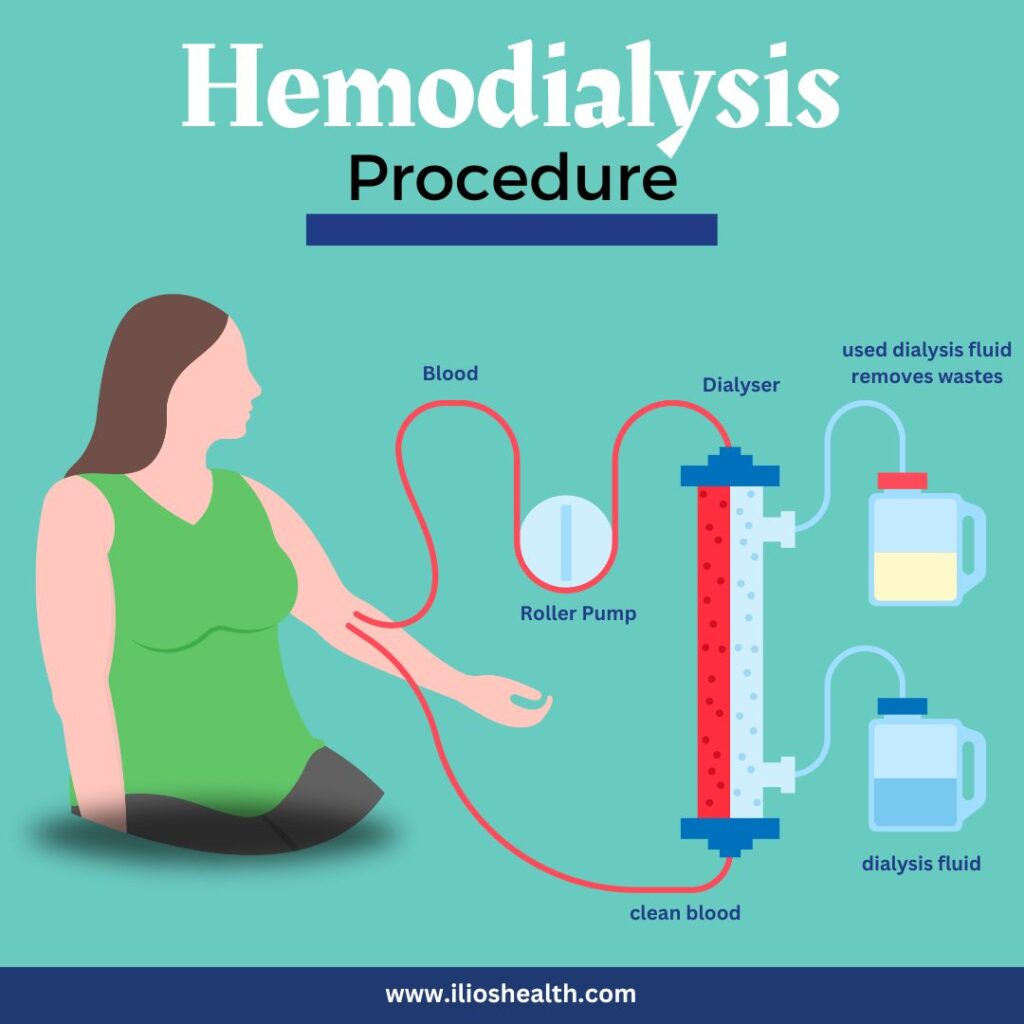 Hemodialysis Procedure