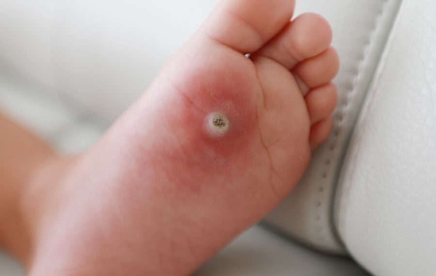 what are warts