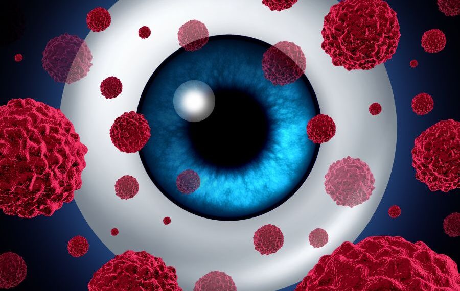 Eye Cancer Symptoms