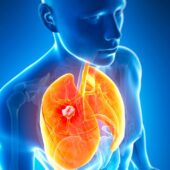 how long can you live with stage 4 lung cancer