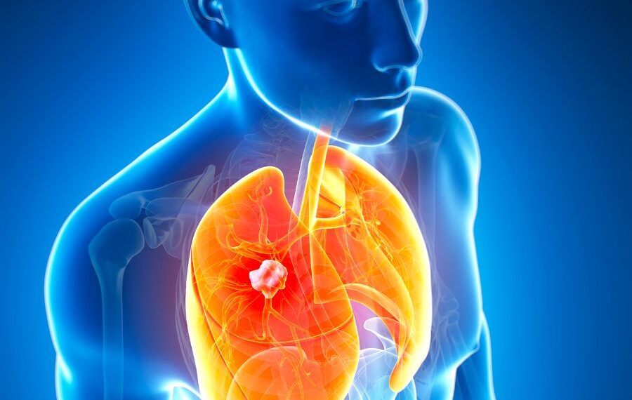 how long can you live with stage 4 lung cancer