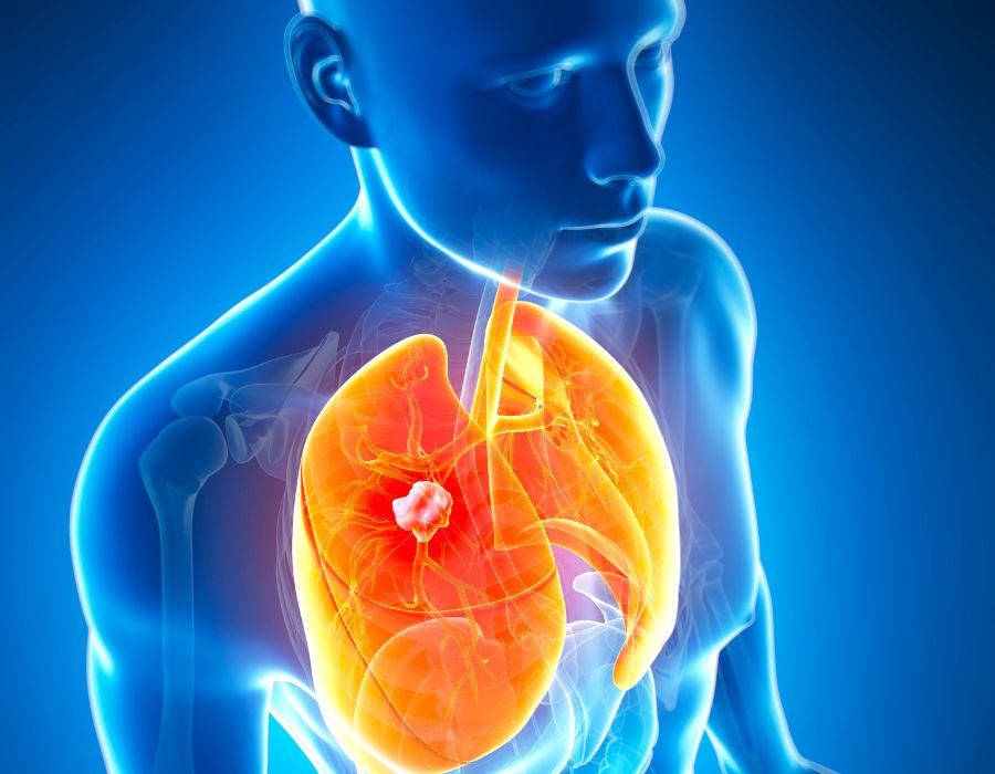 how long can you live with stage 4 lung cancer