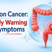 Colon Cancer